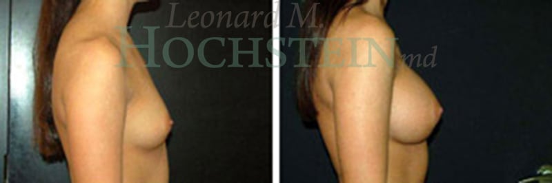 Breast Augmentation Patient