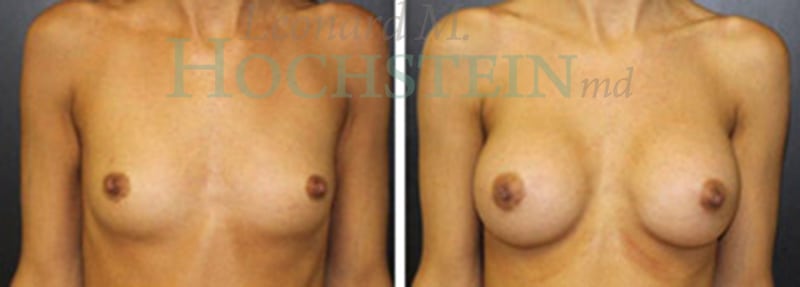 Breast Augmentation Patient