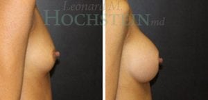 Breast Augmentation Patient