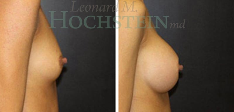 Breast Augmentation Patient
