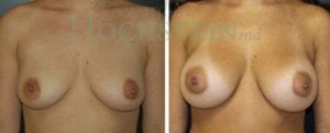 Breast Augmentation Patient