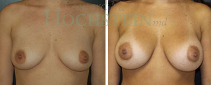 Breast Augmentation Patient