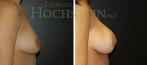 Breast Augmentation Patient