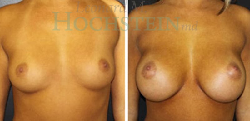 Breast Augmentation Patient