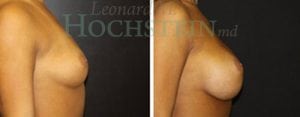 Breast Augmentation Patient