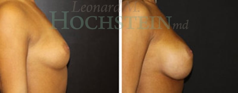 Breast Augmentation Patient