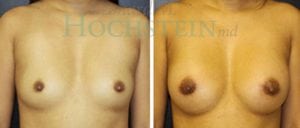 Breast Augmentation Patient