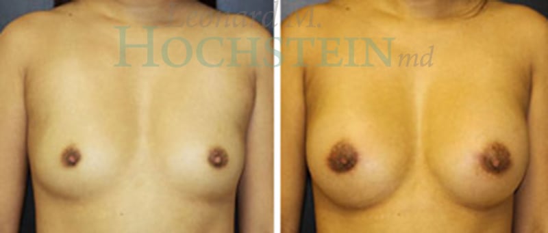 Breast Augmentation Patient