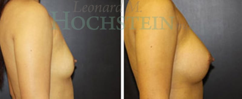 Breast Augmentation Patient