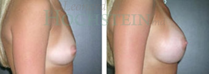 Breast Augmentation Patient