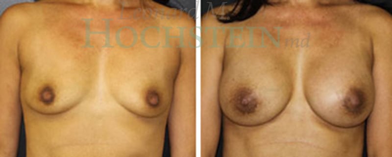 Breast Augmentation Patient