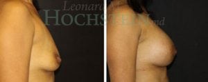 Breast Augmentation Patient