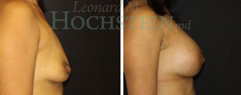Breast Augmentation Patient