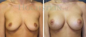 Breast Augmentation Patient