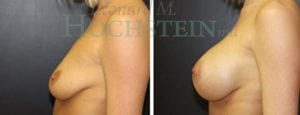 Breast Augmentation Patient