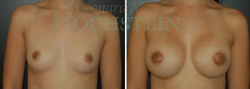 Breast Augmentation Patient