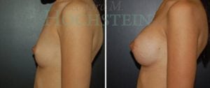 Breast Augmentation Patient