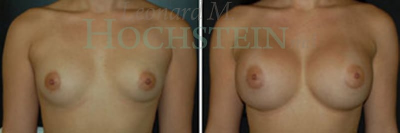 Breast Augmentation Patient