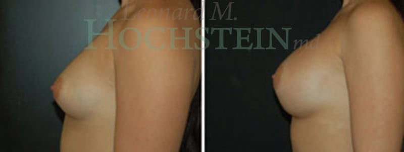 Breast Augmentation Patient