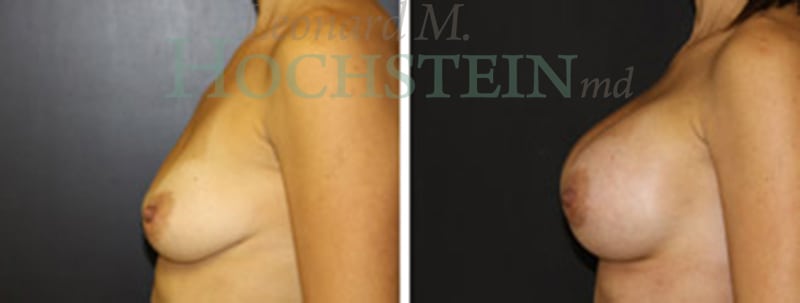 Breast Augmentation Patient