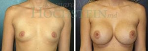 Breast Augmentation Patient