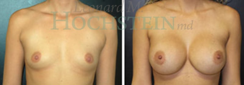 Breast Augmentation Patient