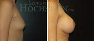 Breast Augmentation Patient