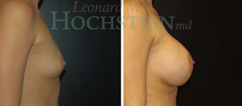 Breast Augmentation Patient