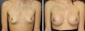 Breast Augmentation Patient