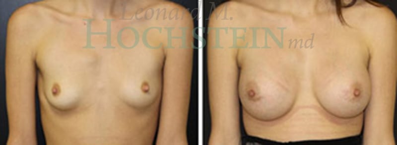 Breast Augmentation Patient