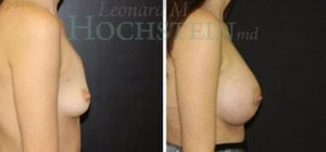 Breast Augmentation Patient