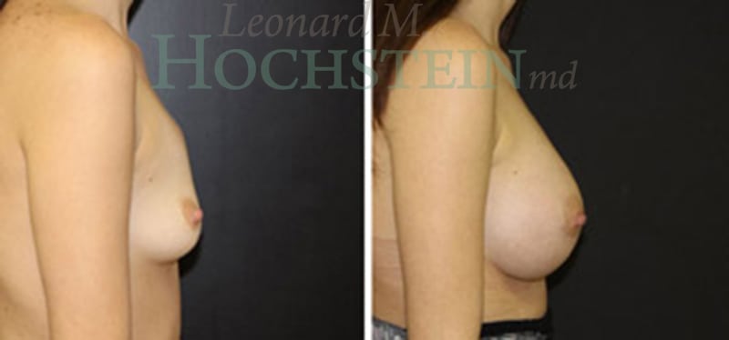Breast Augmentation Patient