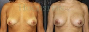 Breast Augmentation Patient