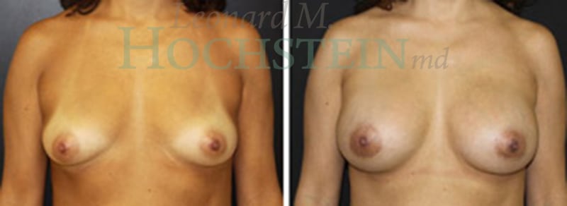 Breast Augmentation Patient