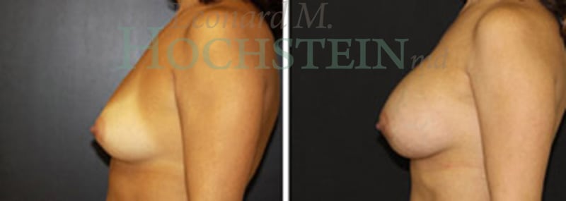 Breast Augmentation Patient