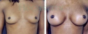 Breast Augmentation Patient