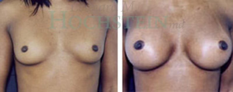 Breast Augmentation Patient