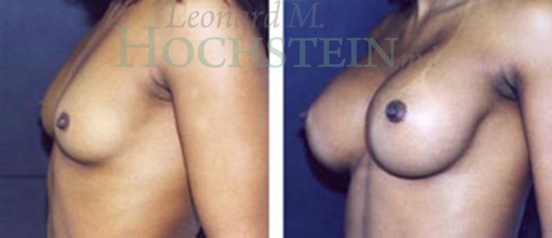 Breast Augmentation Patient