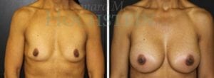 Breast Augmentation Patient