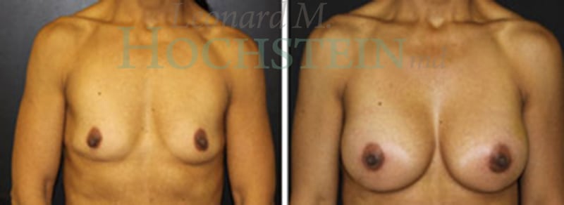 Breast Augmentation Patient