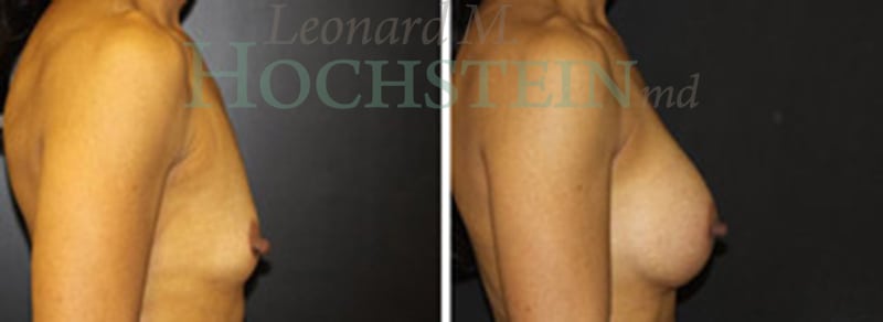 Breast Augmentation Patient