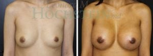Breast Augmentation Patient