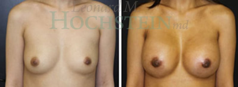 Breast Augmentation Patient