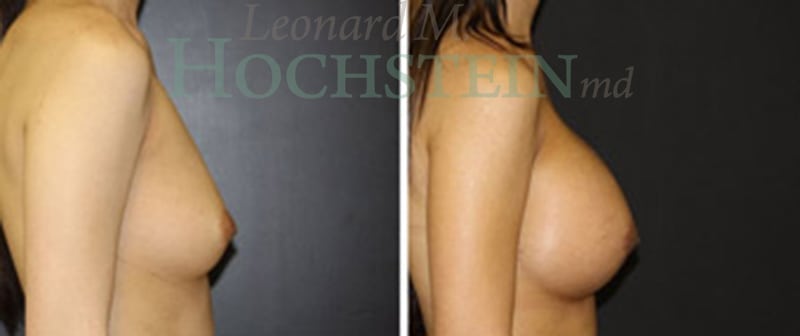 Breast Augmentation Patient