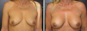 Breast Augmentation Patient
