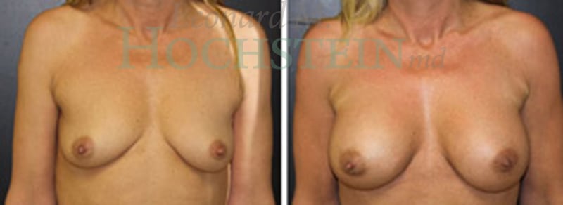 Breast Augmentation Patient