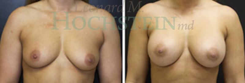 Breast Augmentation Patient