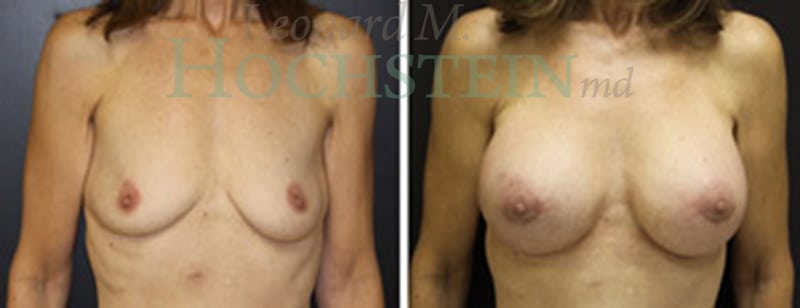 Breast Augmentation Patient