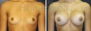 Breast Augmentation Patient