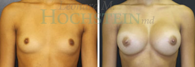 Breast Augmentation Patient